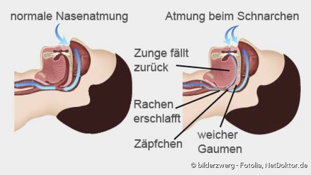 lang geworden Gaumenzäpfchen