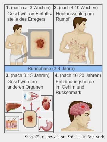 mund spritzen Im