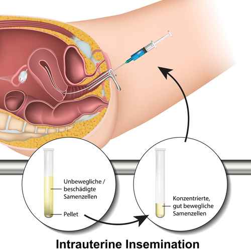 in spritzen Sperma vagina